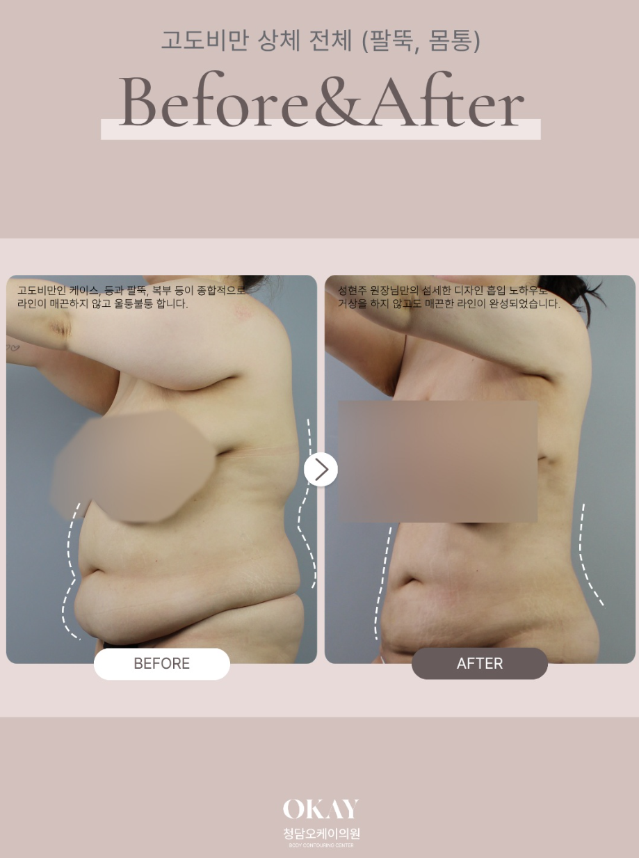 Liposuction for Severe Obesity: What Must Be Checked When Performing Large-Volume Liposuction? image 8