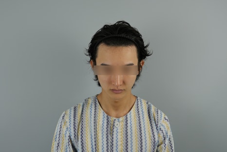 남자헤어라인모발이식, 부자연스러워 보이는 이유를 설명드립니다 관련 이미지 6