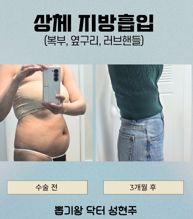 청담지방흡입, 운동해도 유독 안 빠지는 살의 정체는? 관련 이미지 5
