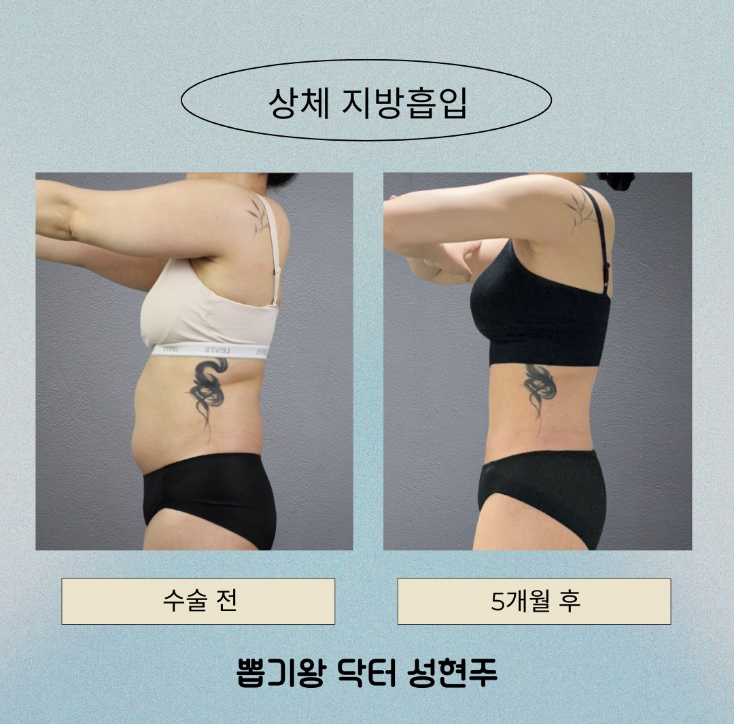 대용량 지방흡입 부작용 있을까? 안전하게 받기 위한 핵심 포인트 관련 이미지 10