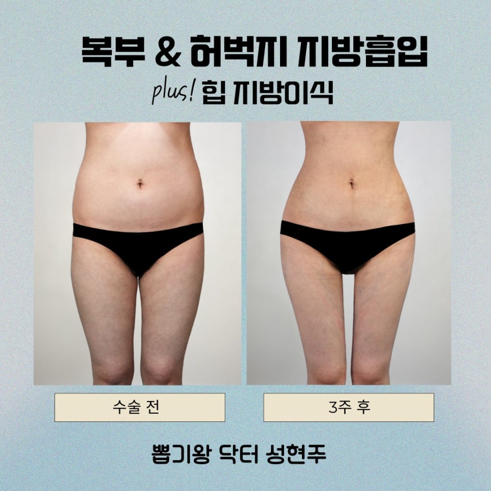 옆구리지방흡입, 허리라인 디자인이 중요한 이유 관련 이미지 2
