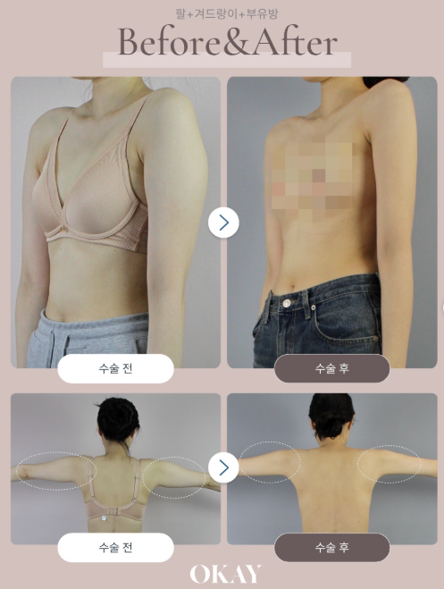 청담지방흡입비용, 팔&middot;복부&middot;허벅지마다 차이가 나는 이유 관련 이미지 6