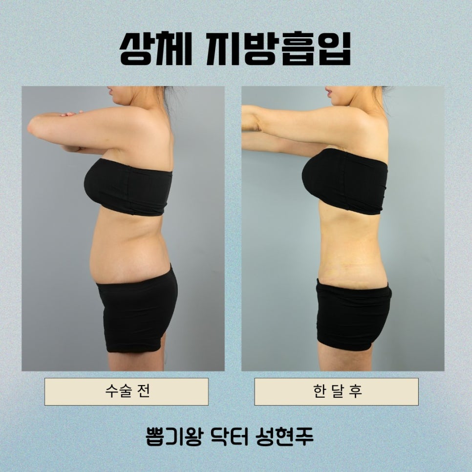 등지방흡입압박복, 꼭 입어야 할까? 회복 결과를 좌우하는 이유 관련 이미지 9