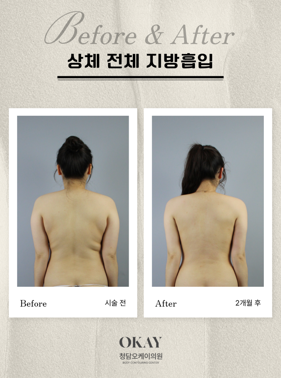 What to Check If You Are Concerned About Unevenness After Back Liposuction image 5