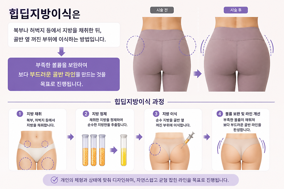 힙딥지방이식, 운동으로 안 채워지는 골반 옆 꺼짐 개선 방법은? 관련 이미지 7