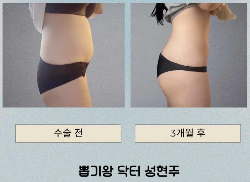 Waist-to-Hip Contouring Liposuction Side Effects: What Changes May Occur During Recovery? image 10
