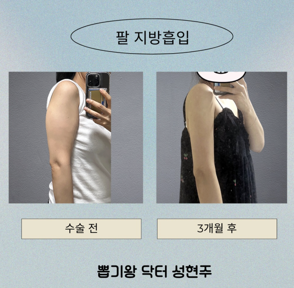 Liposuction Bio-Bond Care: First, Understand Why It Becomes Hard image 9