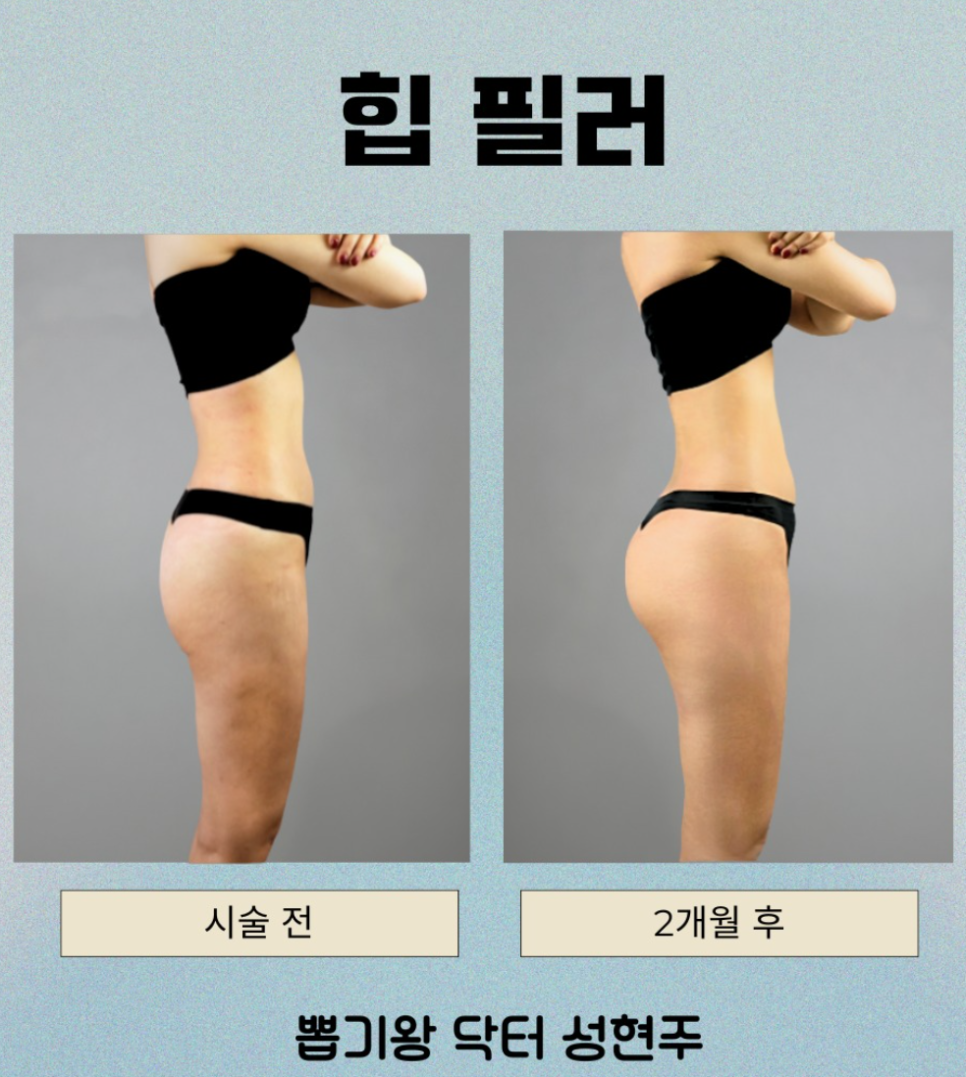엉덩이지흡, 엉밑살 빼면 처짐과 힙딥까지 좋아질까? 관련 이미지 7