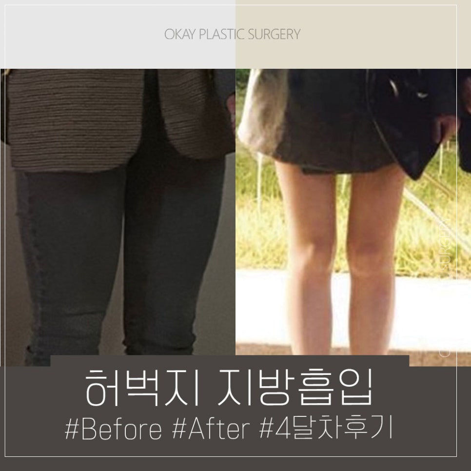 허벅지지방흡입후관리 어떻게 해야 할까? 붓기&middot;압박복&middot;회복기간 기준 정리 관련 이미지 6