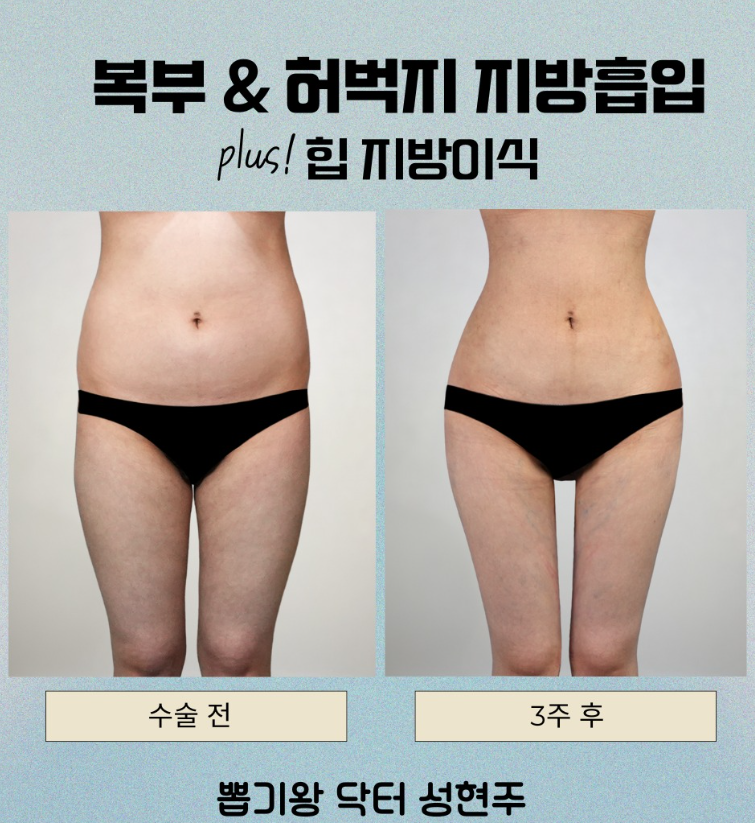 골반지방이식 vs 골반필러, 내 체형에 맞는 선택 기준 총정리 관련 이미지 6
