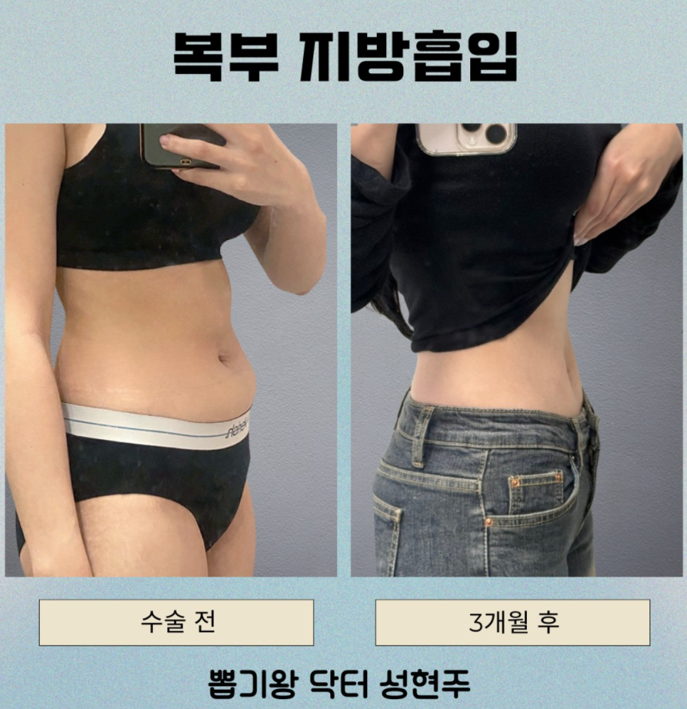 뱃살지흡 후기, 아랫배부터 옆구리까지 어디까지 달라질까요? 관련 이미지 7