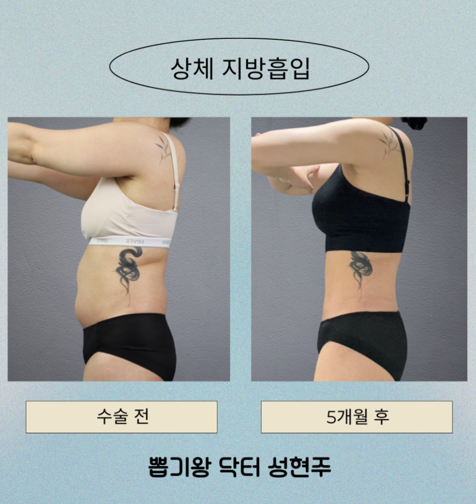 How to Lose Abdominal Fat: When Is Liposuction Needed for Belly Fat That Dieting Can't Remove? image 5