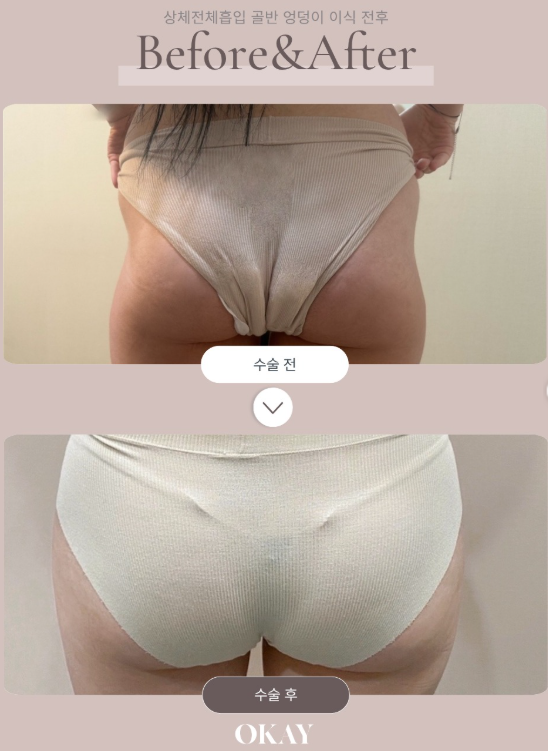 엉덩이지방이식, 힙라인이 달라 보이는 핵심은 따로 있습니다 관련 이미지 4