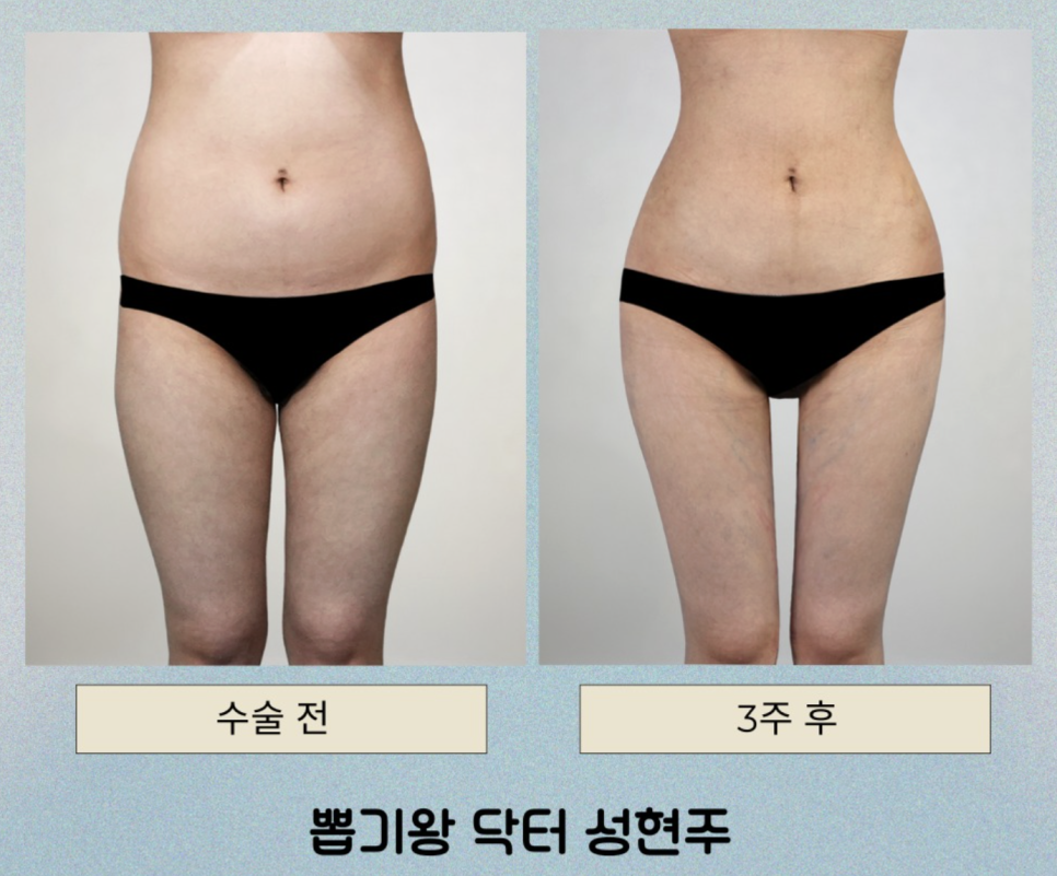허벅지지방흡입후관리, 붓기와 통증을 줄이기 위해 중요한 것은? 관련 이미지 10