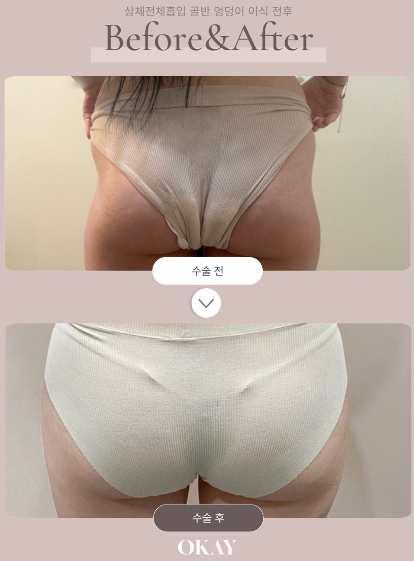 엉덩이지흡, 엉밑살 빼면 처짐과 힙딥까지 좋아질까? 관련 이미지 8