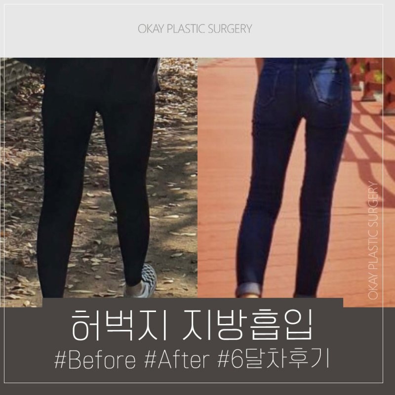 하체비만 허벅지지방흡입 후 변화, 바지핏 달라지는 이유는 따로 있습니다 관련 이미지 4