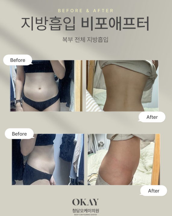 복부지방흡입가격과 효과 비례할까? 허리라인·복부라인 디자인 차이 관련 이미지 4