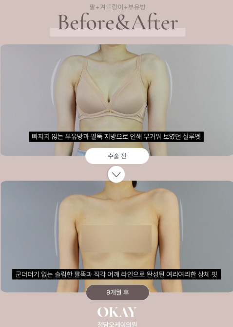 강남팔뚝지방흡입, 살을 빼도 팔뚝만 그대로라면 이유가 있습니다 관련 이미지 6