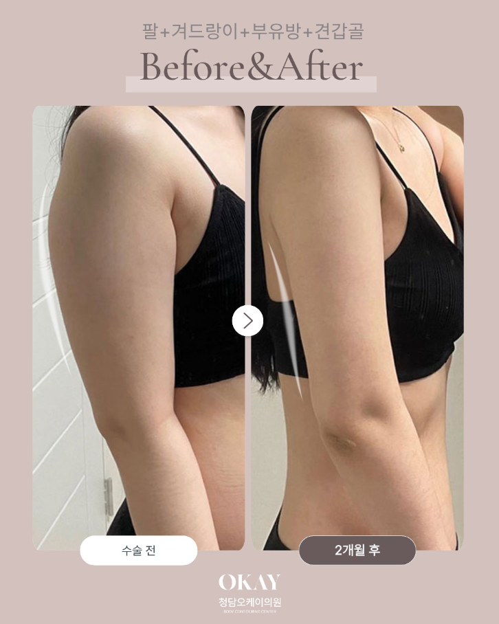 지방흡입 바본 관리 고주파&middot;바이오본드 언제부터 해야 하는지 정리했습니다 관련 이미지 8
