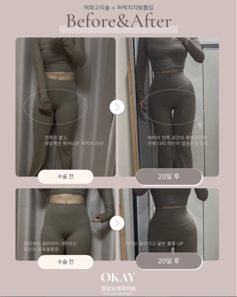 허벅지지방흡입 출근, 며칠부터 가능할까요? 회복 과정 함께 알아보기 관련 이미지 4