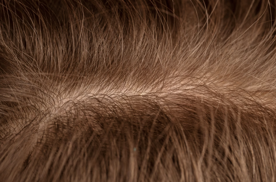 Incision vs. Non-Incision Hair Transplantation: A Complete Guide to the Differences and Selection Criteria image 4