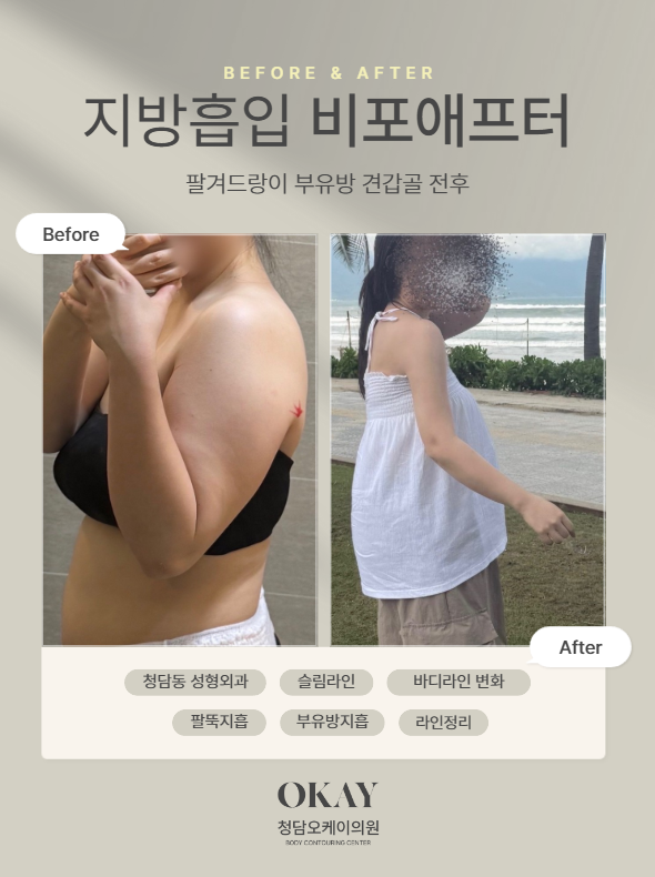 Why Is Aftercare Important After Arm Liposuction? Compression Garments, Massage, and Swelling Management Explained image 8