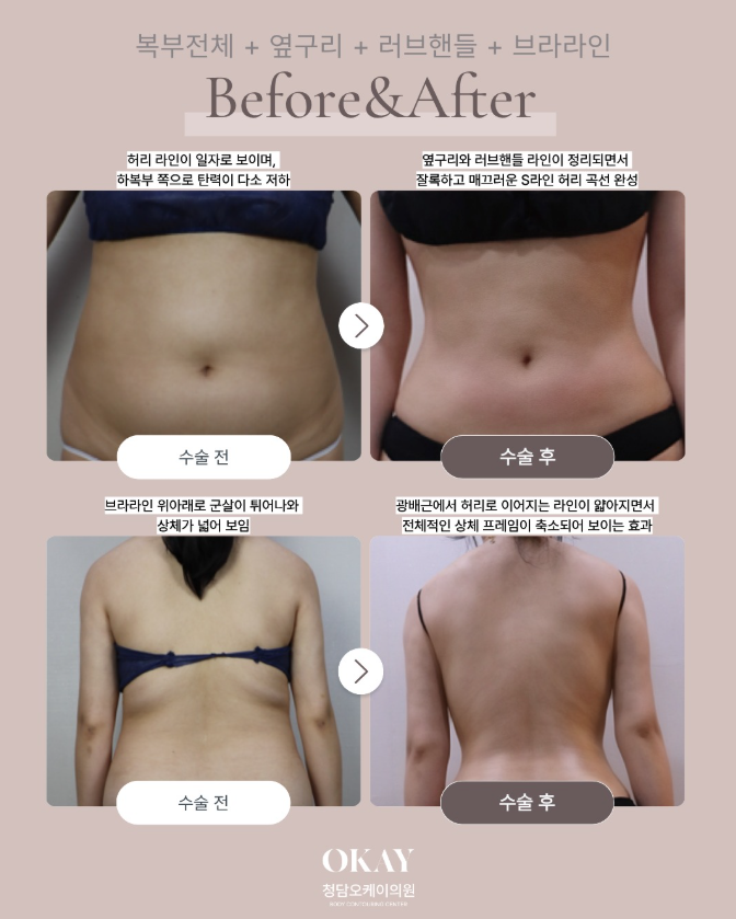 압구정 다이어트, 지방흡입 후기로 보는 부위별 라인 변화 관련 이미지 9