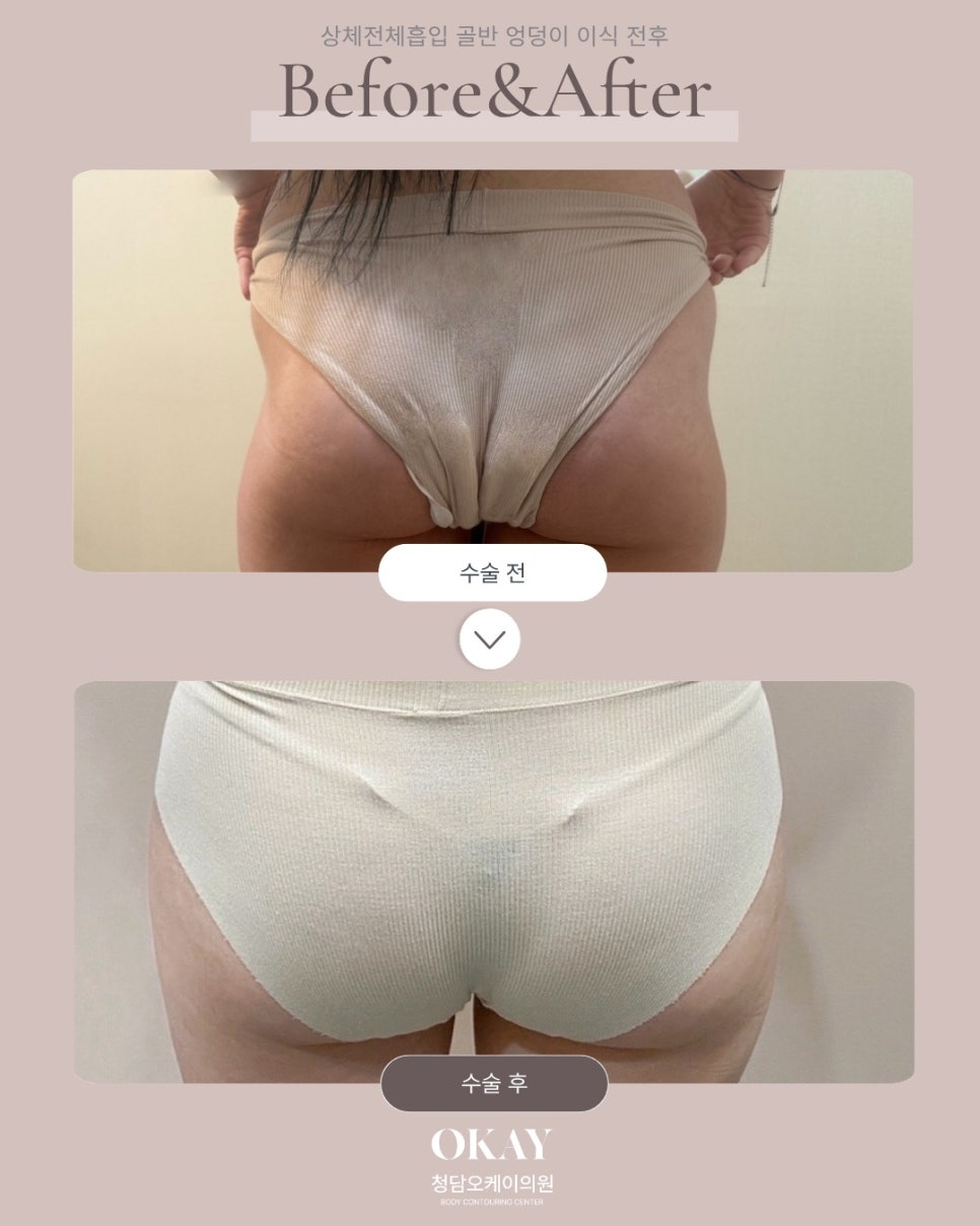 서울지방이식잘하는곳, 자연스러운 볼륨을 만드는 차이는 어디서 생길까요? 관련 이미지 7
