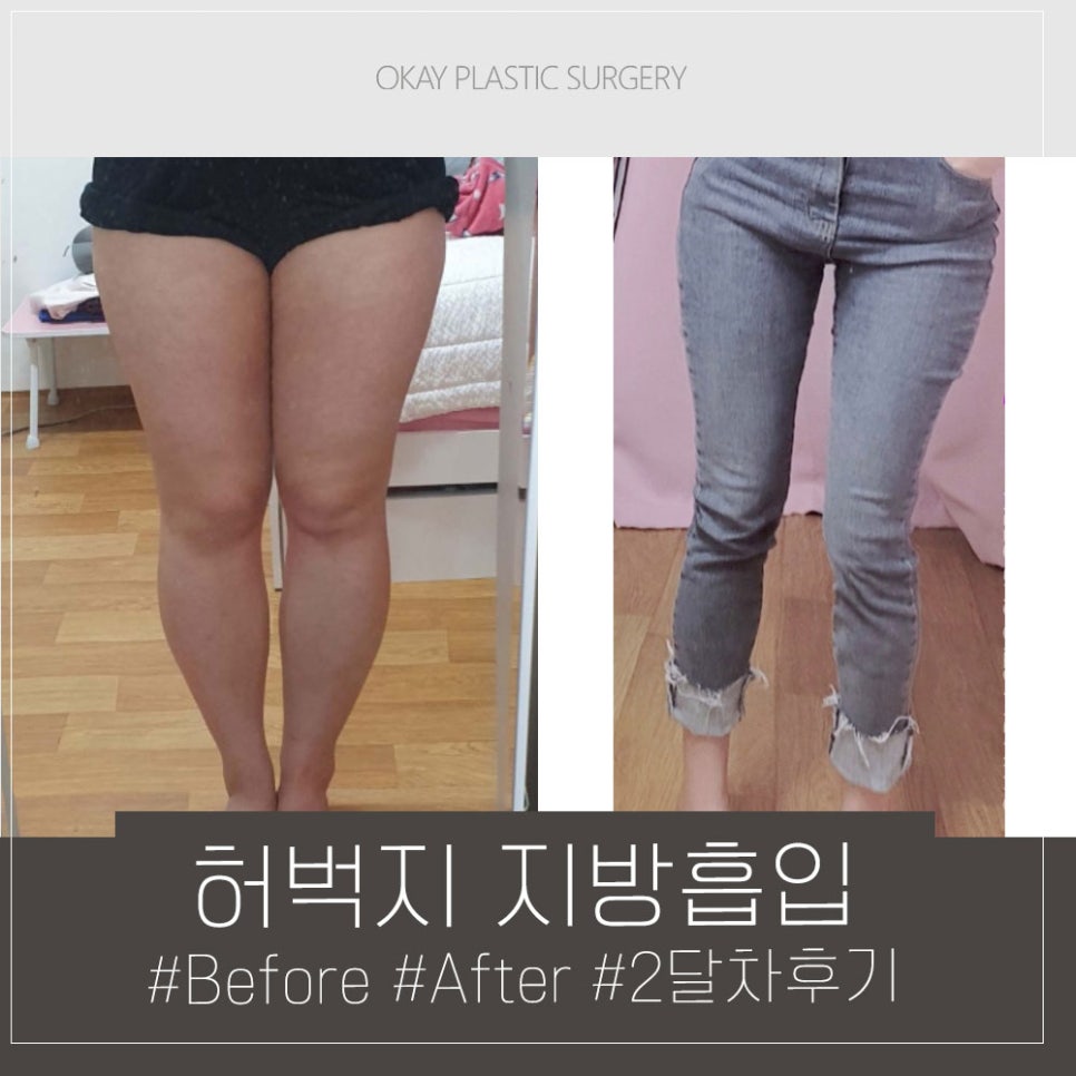 압구정로데오 성형외과 지방흡입&middot;지방이식 잘하는곳, 효과와 통증&middot;붓기&middot;멍 정리 관련 이미지 7