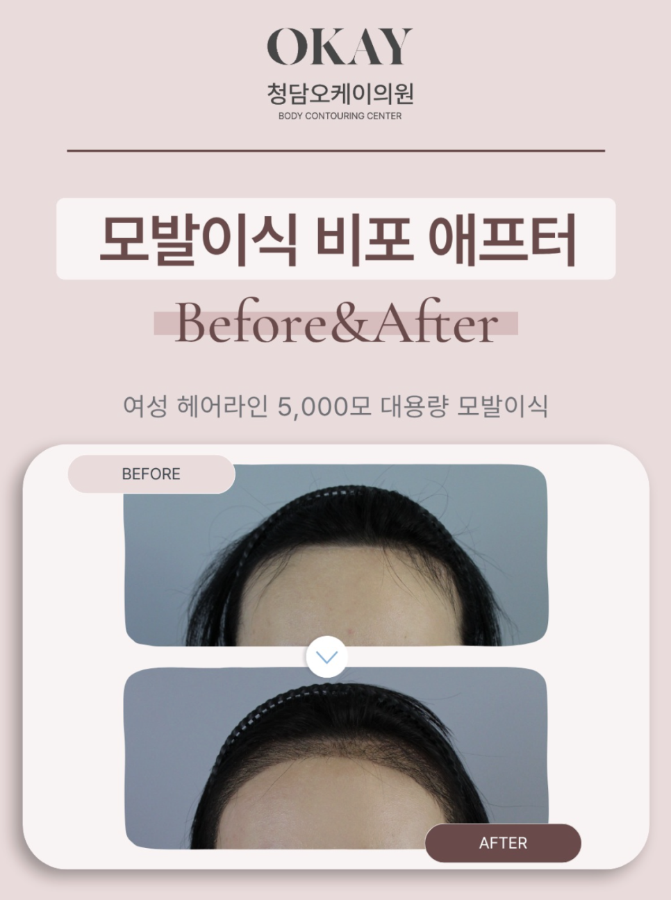 Incision vs. Non-Incision Hair Transplantation: A Complete Guide to the Differences and Selection Criteria image 2