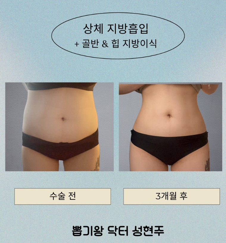 골반지방이식 후기, 만족한 사람들은 무엇이 달랐을까요? 관련 이미지 6