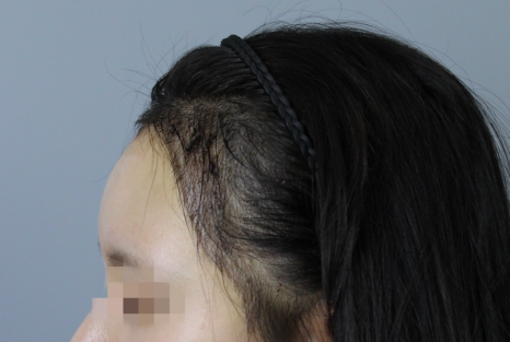 절개모발이식 뒷머리 흉터 얼마나 남나요 &ndash; 후기&middot;부작용 현실 정리 관련 이미지 7