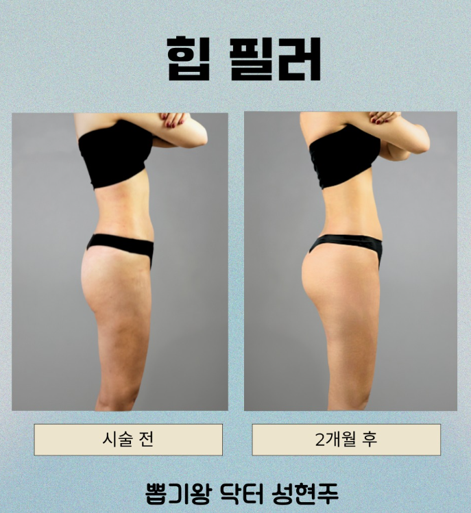 엉덩이지방이식, 힙라인이 달라 보이는 핵심은 따로 있습니다 관련 이미지 7