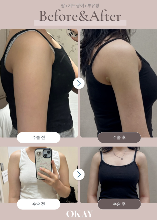 부유방지방흡입, 팔뚝살인 줄 알았는데 빠지지 않는 이유 관련 이미지 6
