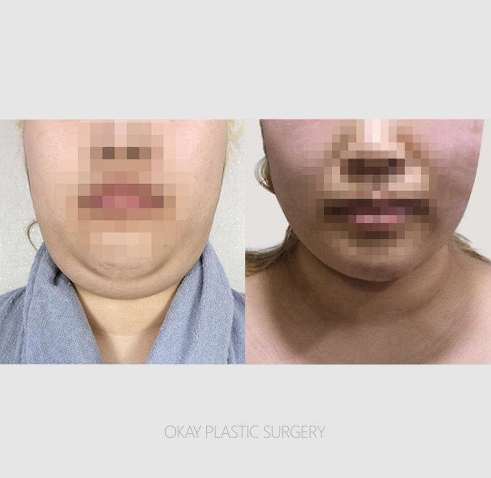 턱지방흡입, 살은 안 쪘는데 이중턱만 고민이라면 관련 이미지 10