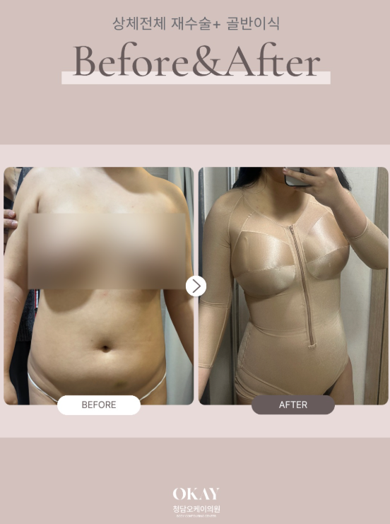 지방흡입압박복, 회복기간 동안 꼭 입어야 할까? 붓기·멍까지 알아보기 관련 이미지 8
