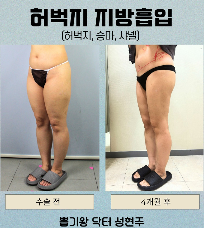 Thigh Liposuction: What If Your Thighs Don’t Slim Down Even with Exercise? image 10