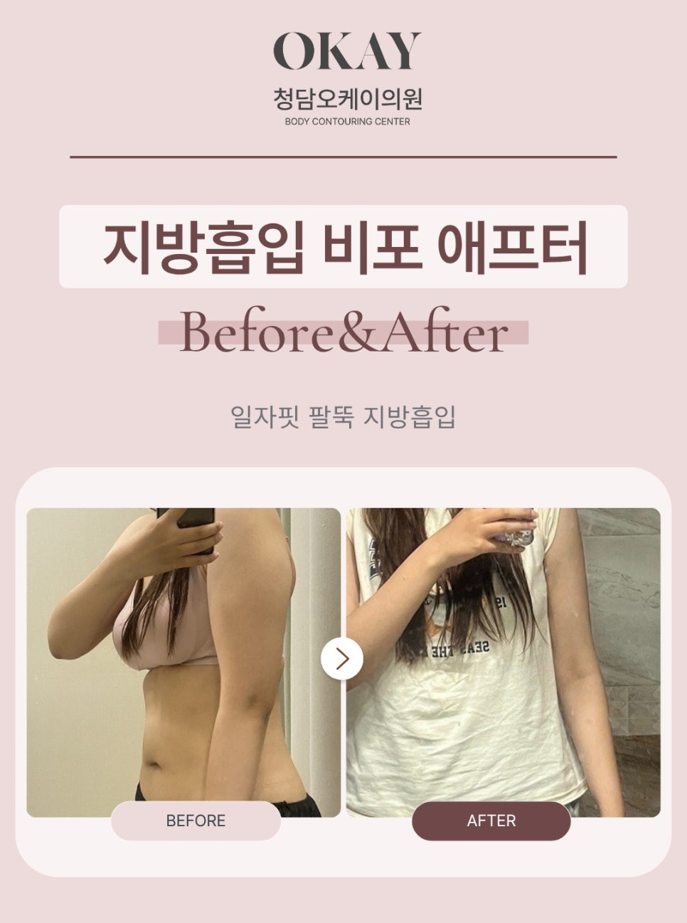 팔지방흡입, 많이 빼는 것보다 중요한 관련 이미지 10