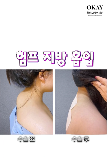 험프지방흡입, 튀어나온 등살 원인부터 확인하세요 관련 이미지 8