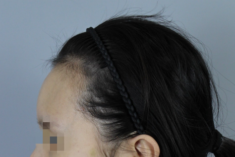 절개모발이식 뒷머리 흉터 얼마나 남나요 &ndash; 후기&middot;부작용 현실 정리 관련 이미지 6