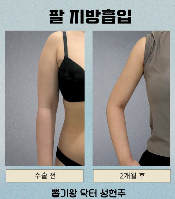 부유방제거수술, 겨드랑이 살만 빼면 될까요? 수술 전 확인할 점 관련 이미지 4