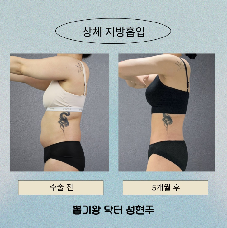 복부지흡 회복기간 얼마나 걸릴까? 붓기&middot;압박복&middot;일상 복귀 기준 관련 이미지 12