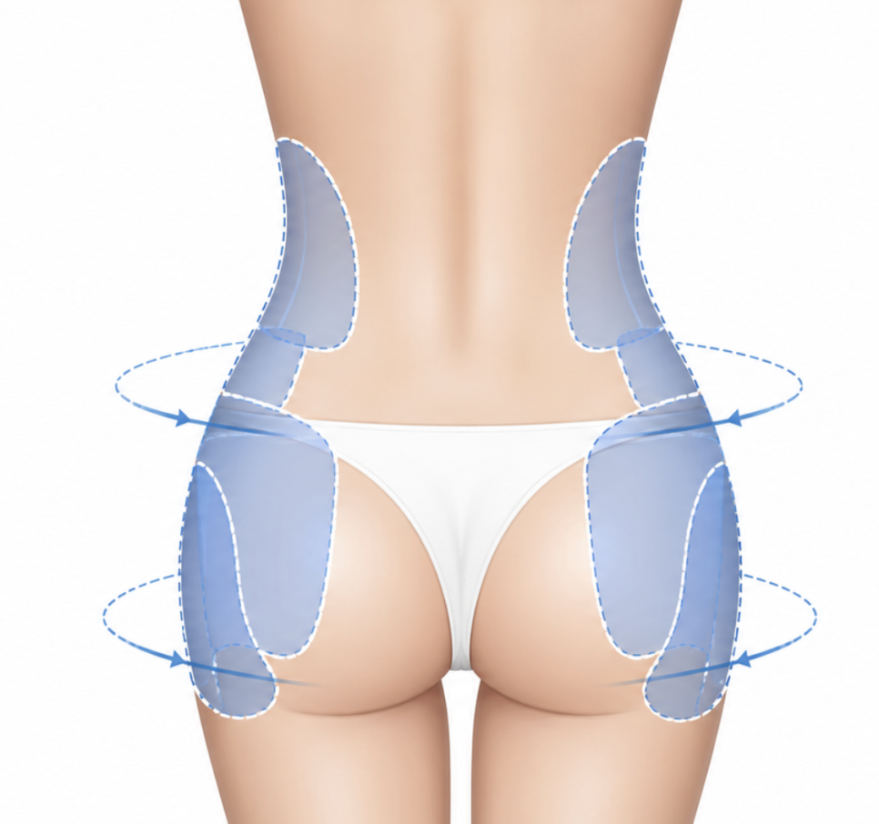 Waist-to-Hip Contouring Liposuction Side Effects: What Changes May Occur During Recovery? image 4