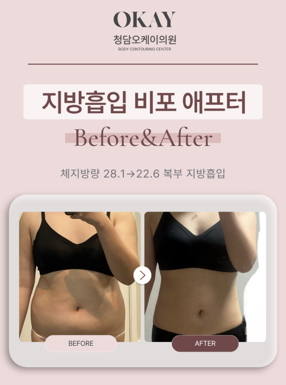 복부지방흡입 후 회복 과정, 언제부터 라인이 달라질까요? 관련 이미지 10
