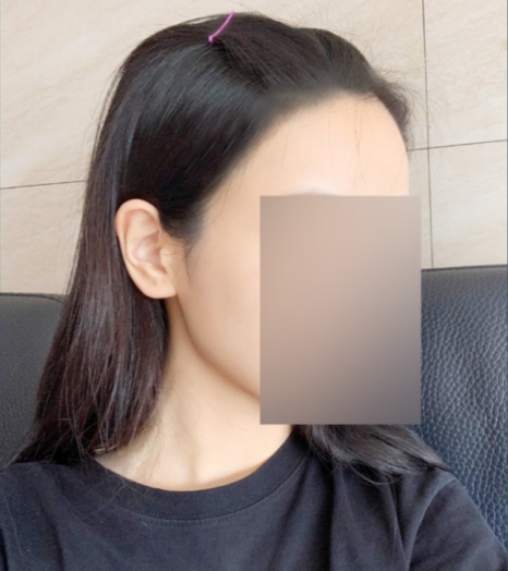 절개모발이식 뒷머리 흉터 얼마나 남나요 &ndash; 후기&middot;부작용 현실 정리 관련 이미지 5