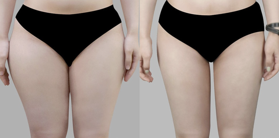안쪽허벅지지방흡입, 바지 핏이 달라지는 핵심은 이것입니다 관련 이미지 2