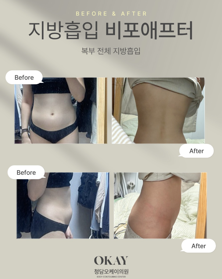 지흡흉터 언제 흐려질까? 치료·레이저·관리 방법 함께 정리 관련 이미지 10