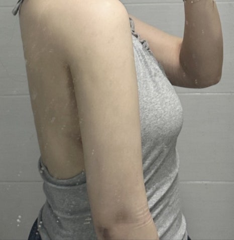 Arm Liposuction Review, How Long Do Swelling and Pain Last? Explanation of Recovery Criteria image 8