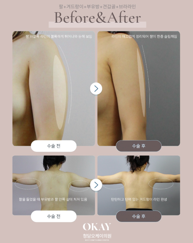 Post-Liposuction Lumpiness Management: Essential Care Tips for Reducing Hardness image 8