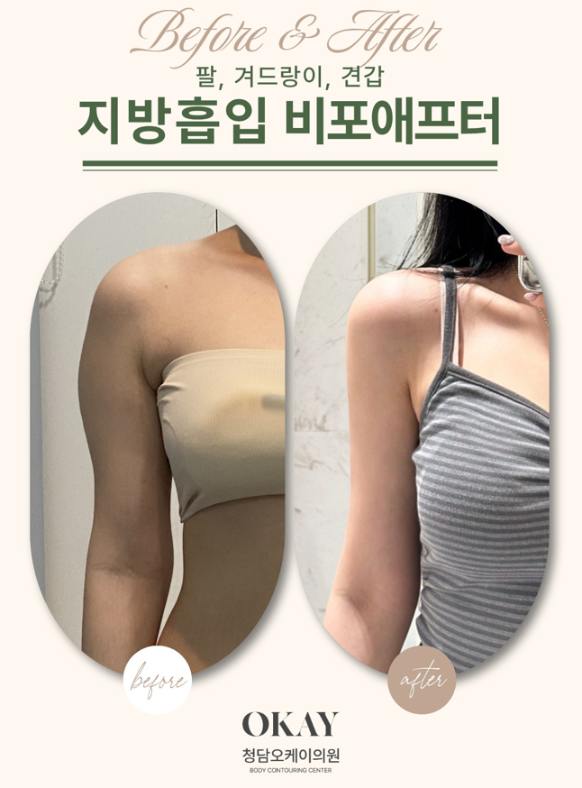 Arm Liposuction Review: A Clear Overview of the Recovery Process and Changes in Contour image 3